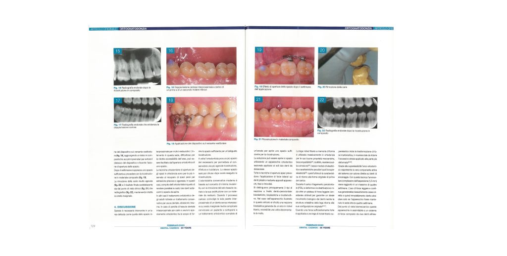 Pubblicato su Dental Cadmos di febbraio l’articolo che parla del dispositivo OBICE  brevettato dal dott. Pascoletti